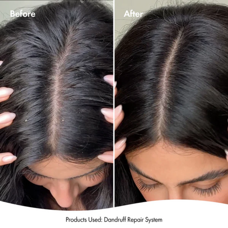 BONDI BOOST Dandruff Repair Leave-In Scalp Serum-125ml