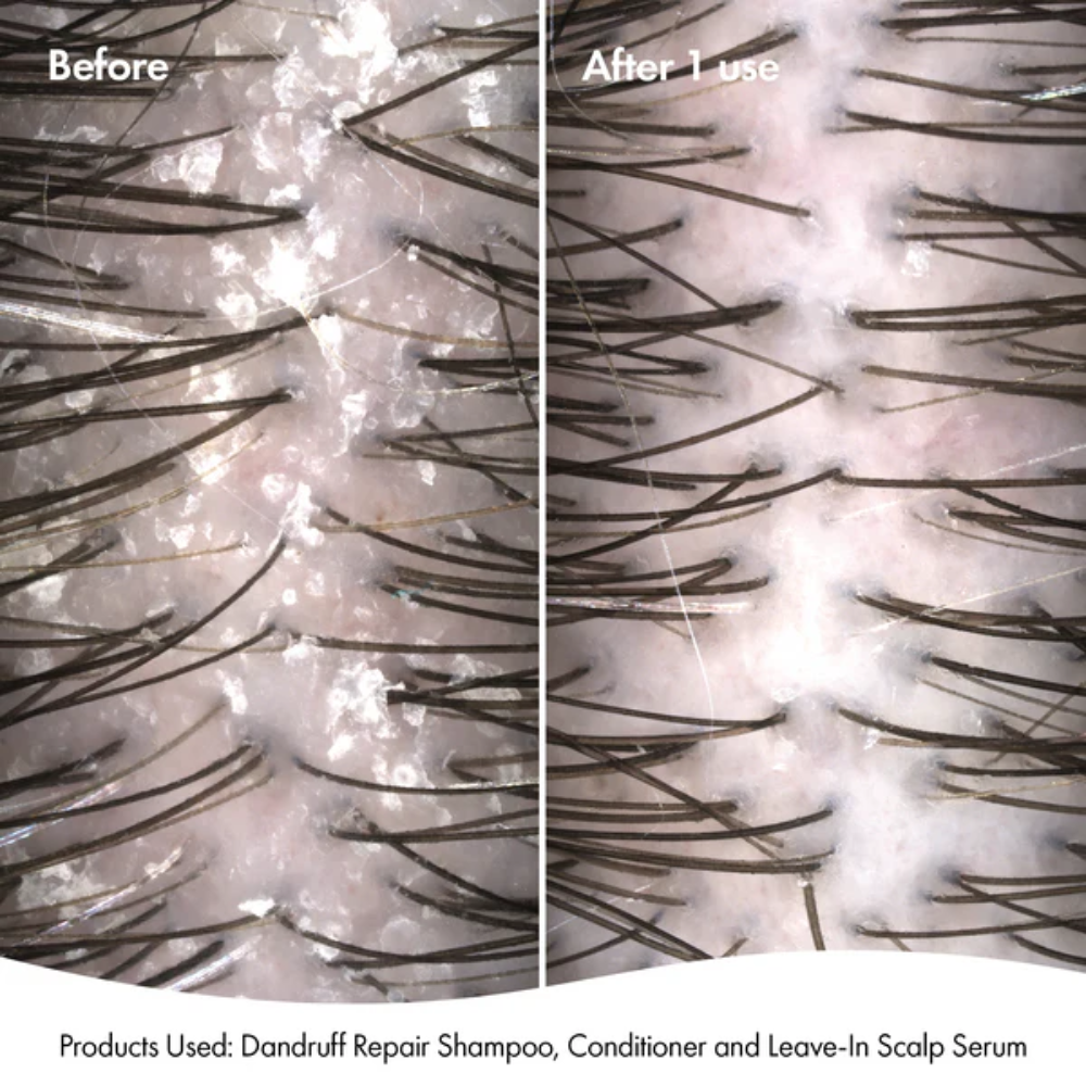 BONDI BOOST Dandruff Repair Leave-In Scalp Serum-125ml